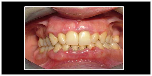 Diş Eti Hastalıkları 2 Dentplus Diş Eti Hastalıkları