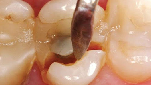 Diş kırıklarının tedavisi var mıdır? Dentplus Diş Eti Hastalıkları