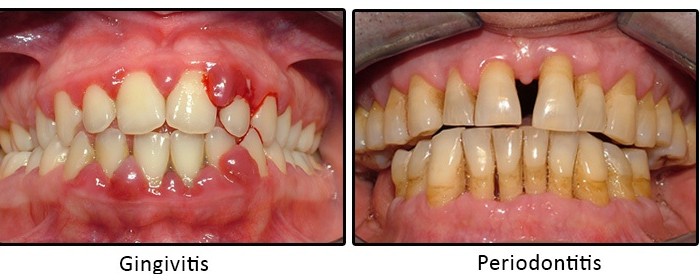 Tag Diş Eti Hastalıkları Uzmanı Dentplus Diş Eti Hastalıkları