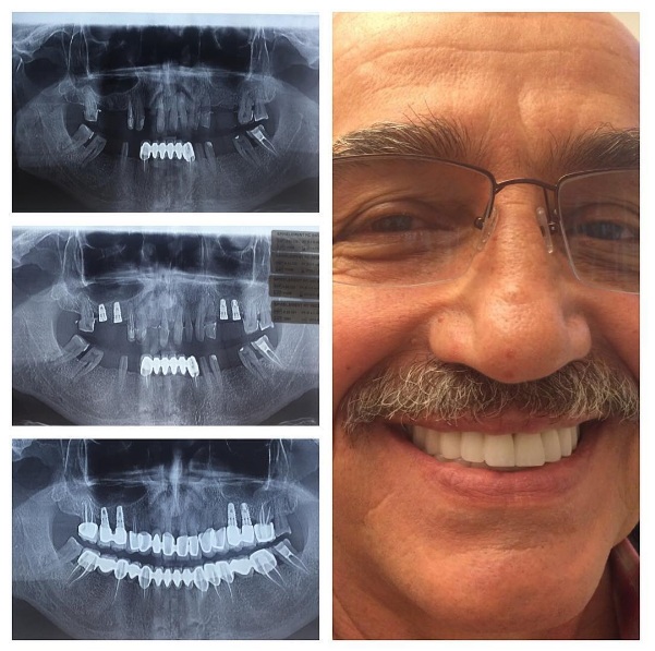 Ortodontik tedavi istemeyen hastanın protetik tedavisi