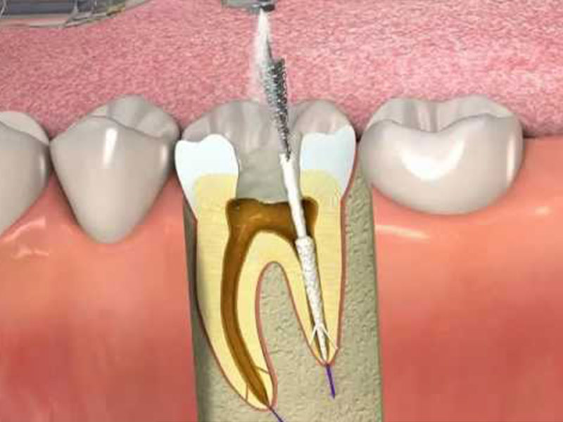 kanal-tedavisi-ve-dişlerde-renklenme.jpg